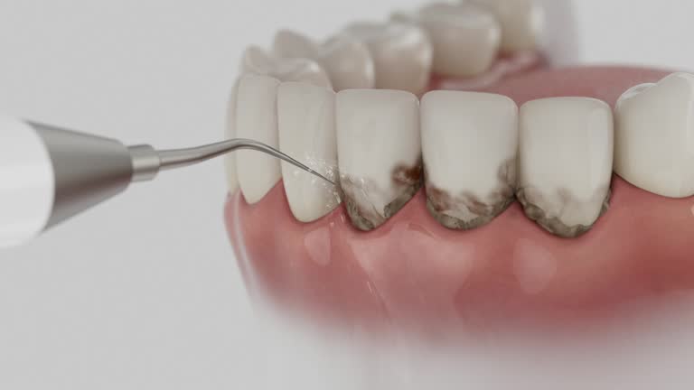 Trusted Wisdom Tooth Removal service in Phillipsburg, NJ - Dentist Open Now